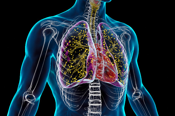 Suma Chihuahua 666 casos de tuberculosis en 2026